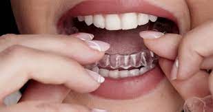 Aligners
